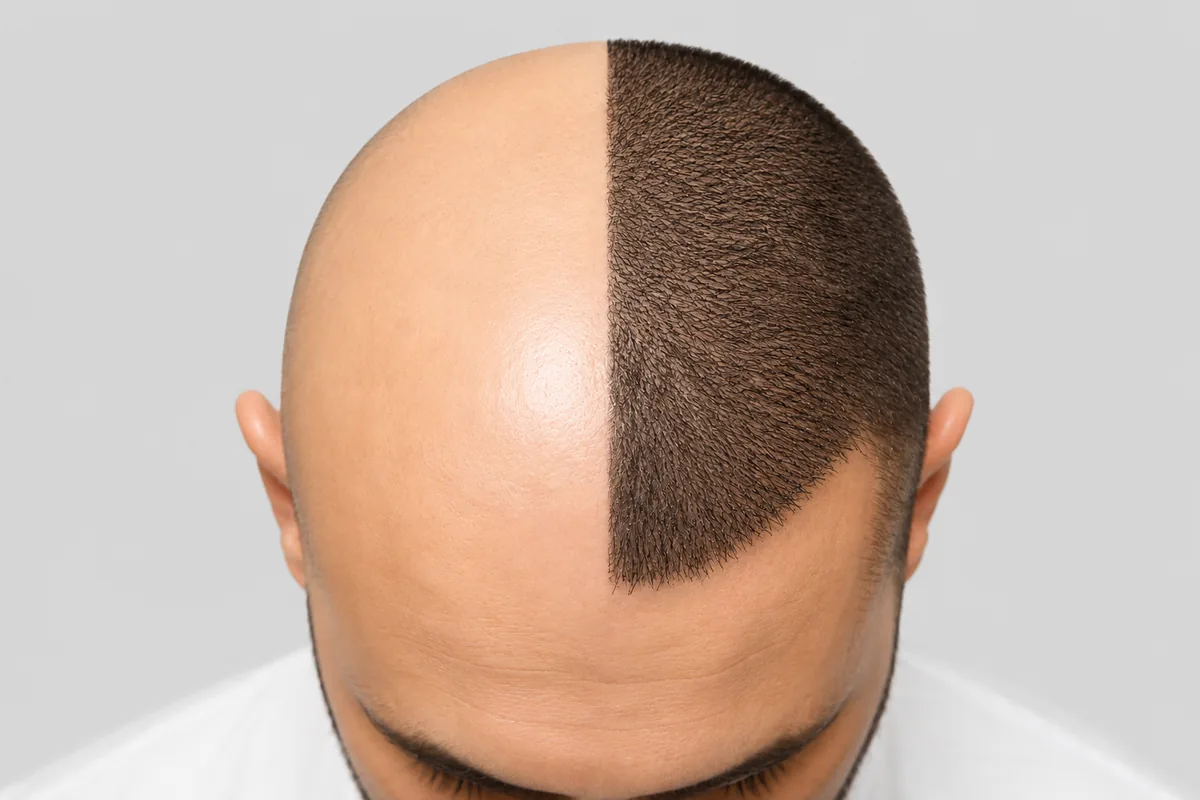 Image of Male Hair Transplant