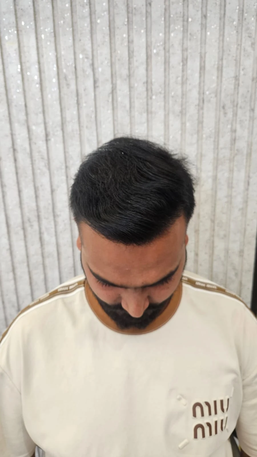 Crown hair restoration dense results - OZONE Ahmedabad