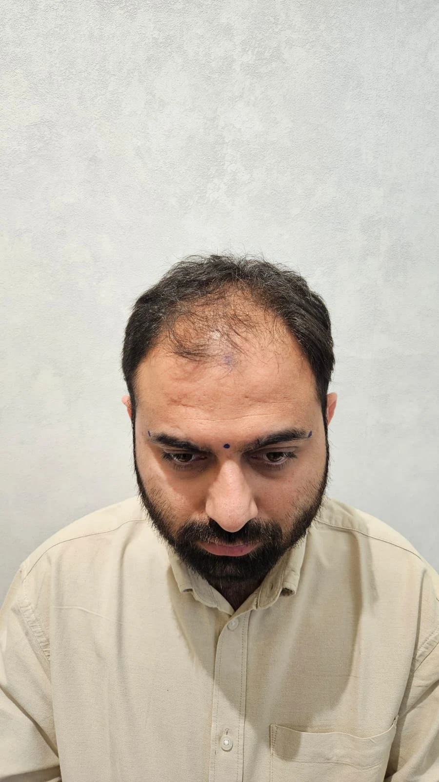 Hair transplant in Ahmedabad before treatment - OZONE