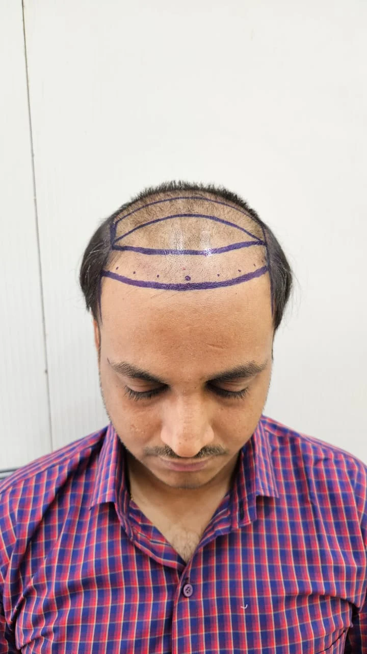 Hair restoration hairline before treatment - OZONE Ahmedabad
