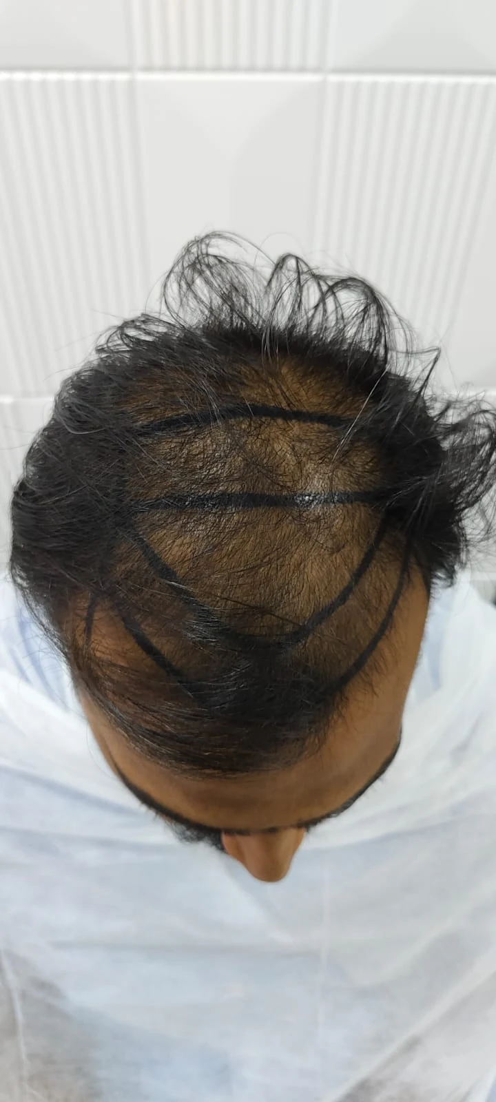 Crown and top scalp hair transplant planning - OZONE Ahmedabad