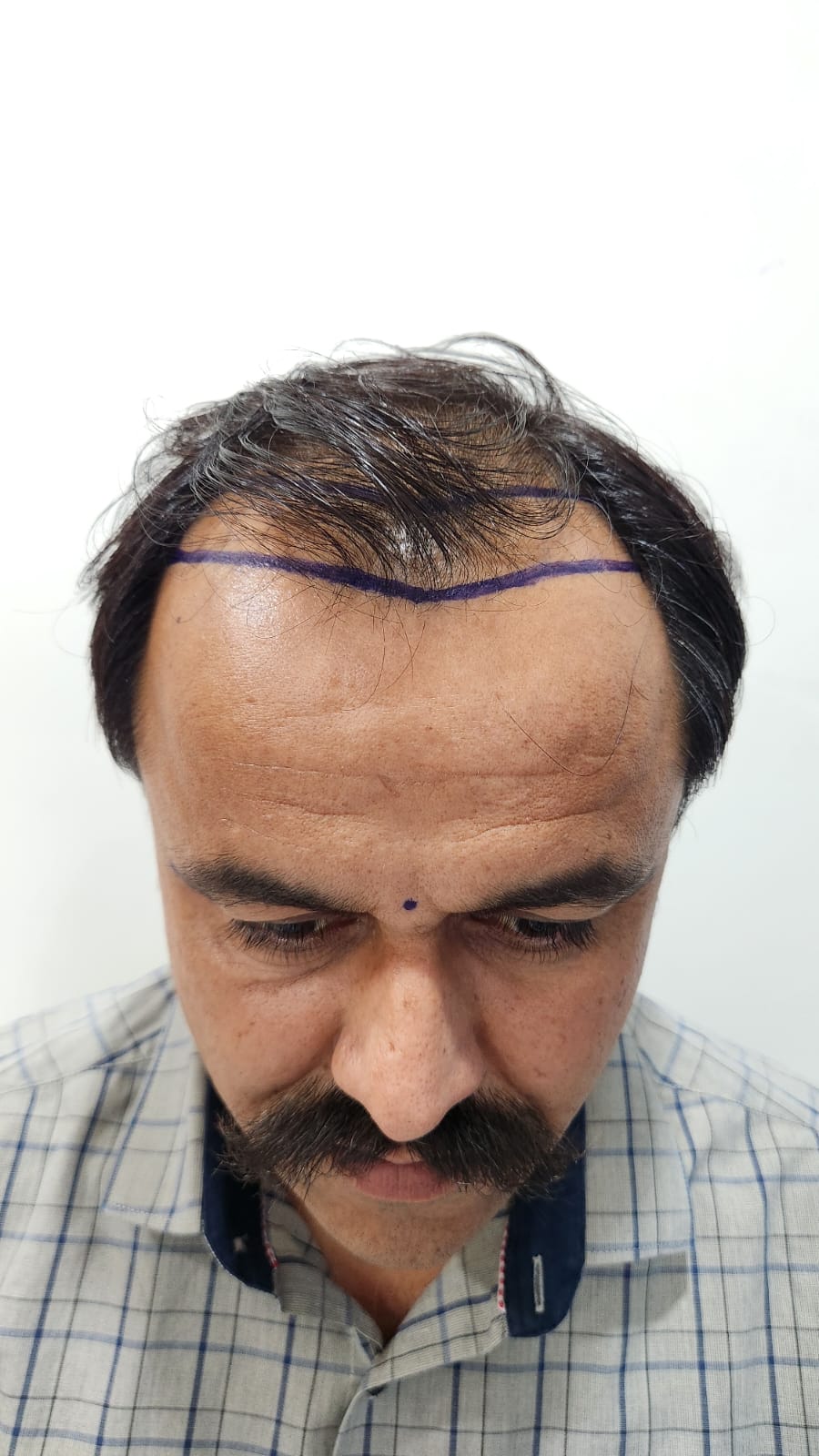 Advanced receding hairline before transplant - OZONE