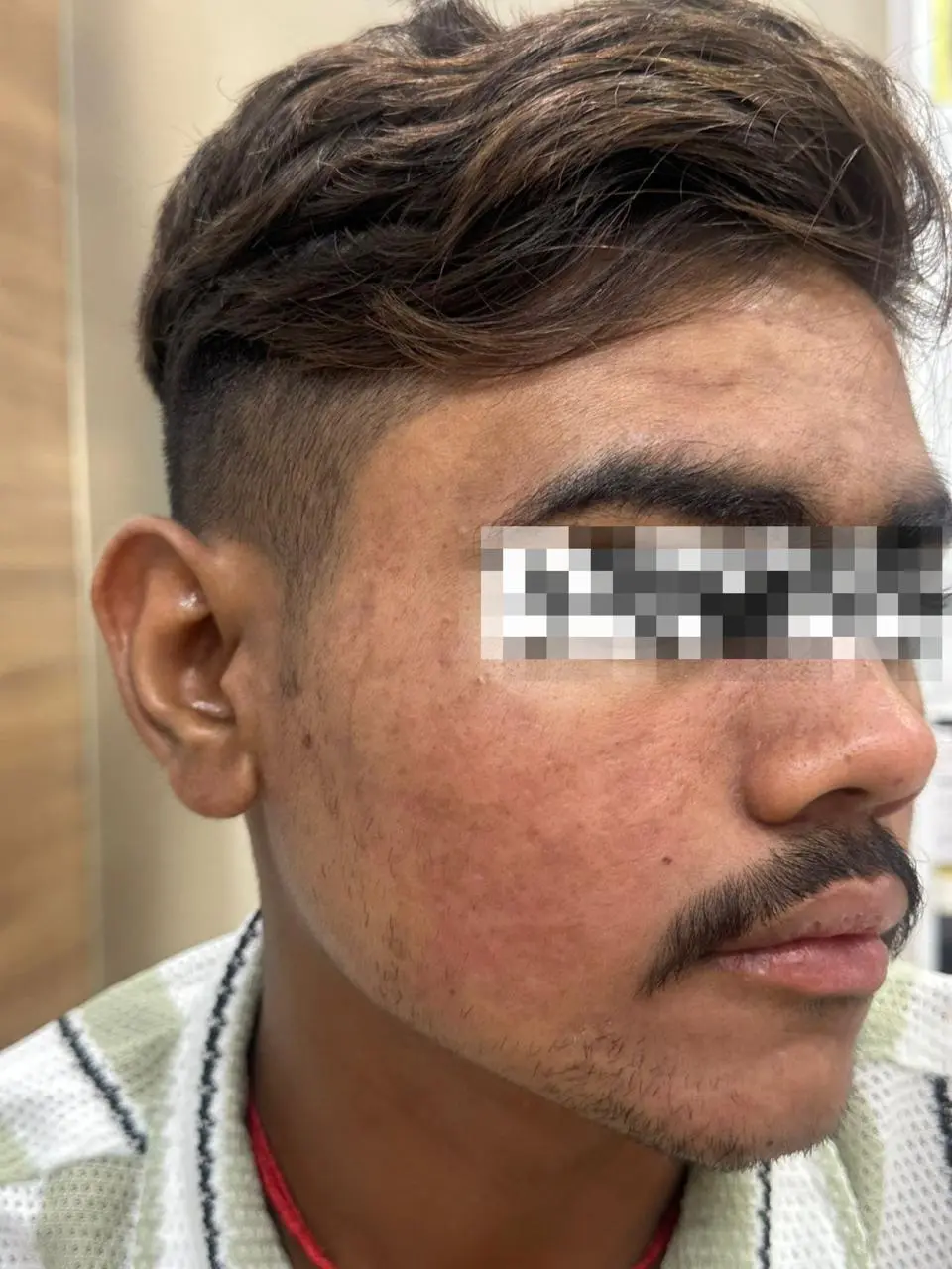 Healed smooth skin after acne treatment - OZONE Ahmedabad