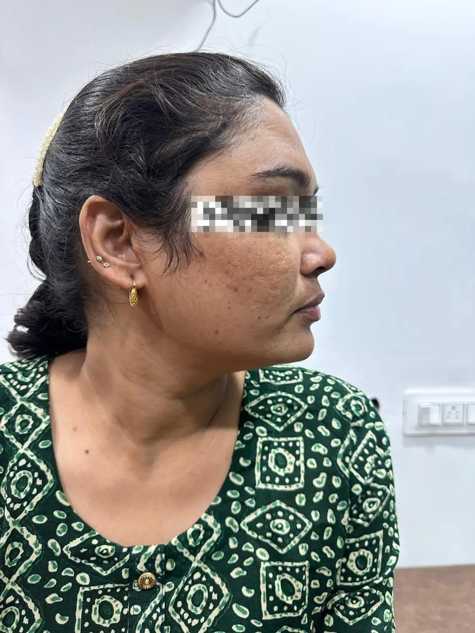 Even radiant tone after pigmentation treatment - OZONE Ahmedabad