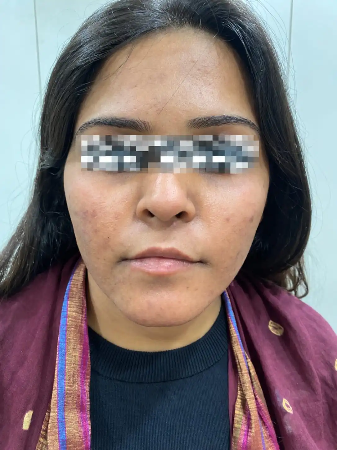 Radiant clear complexion after treatment - OZONE Ahmedabad