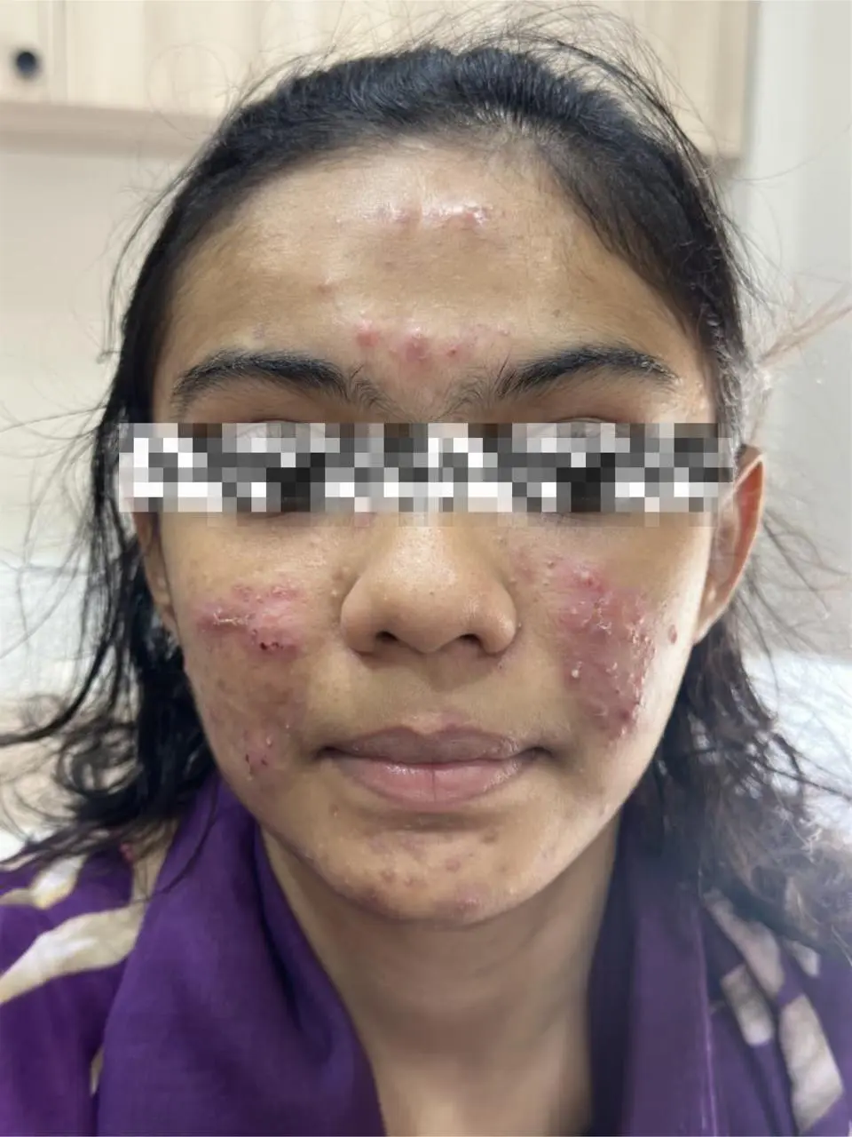 Severe facial acne before treatment - OZONE Skin Clinic Ahmedabad