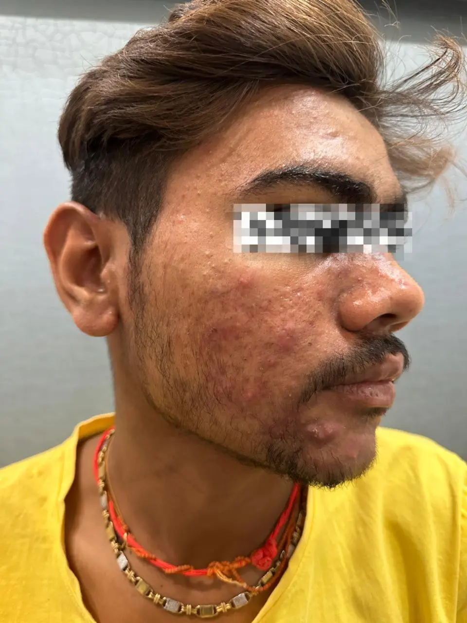 Severe cheek acne before treatment - OZONE Ahmedabad