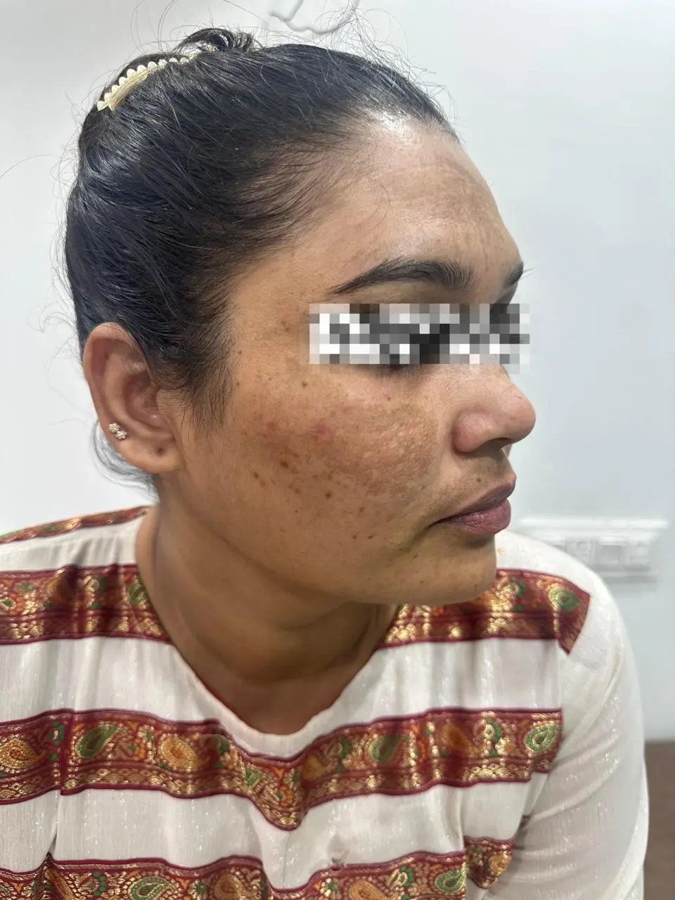 Melasma and pigmentation before treatment - OZONE Ahmedabad