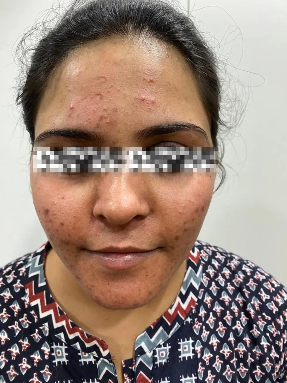 Facial acne and blemishes before treatment - OZONE Ahmedabad